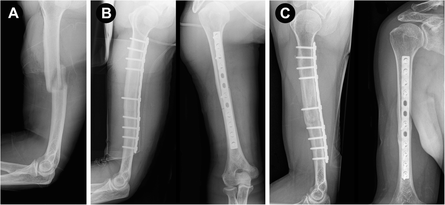 Open Reduction of Fracture